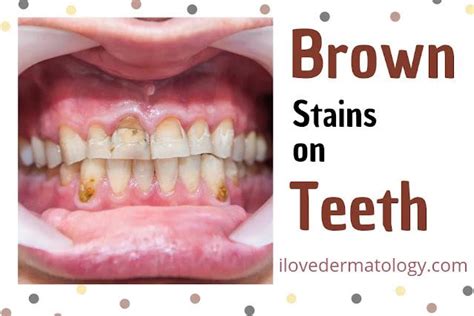 Brown Stains on Teeth : r/ilovedermatology