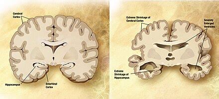 Motivation and emotion/Book/2017/Dementia and vocally disruptive ...