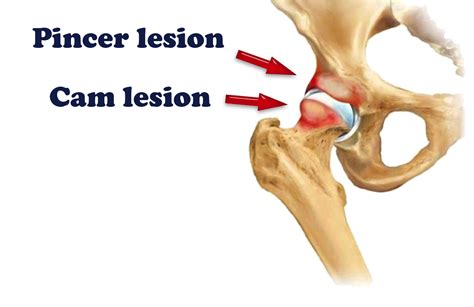 pincer cam hip arthroscopy kochi hip pain - DOCJOINTS//DR SUJIT JOS//Total joint replacements ...