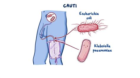 Catheter-associated urinary tract infection: Clinical sciences ...