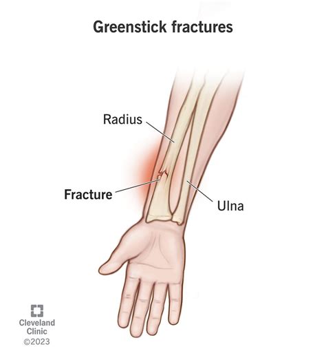 Greenstick Fracture Diagram