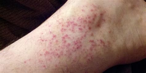 Heat Rash Symptoms, Causes, Diagnosis and Treatment | Natural Health News