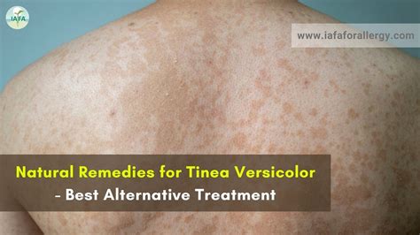 Natural Remedies for Tinea Versicolor - Best Alternative Treatment