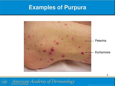 Ecchymosis Vs Petechiae