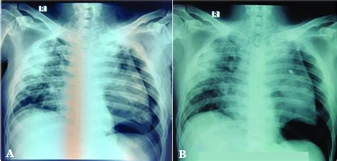 (A) Chest X-ray on admission and (B) chest X-ray after two weeks of ...