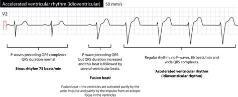 Figure 2. Sinus rhythm intervened by a fusion beat and then ...