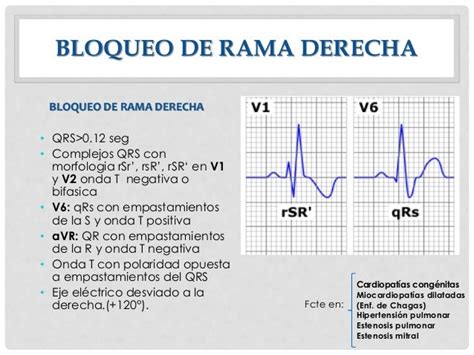 Bloqueos cardiacos