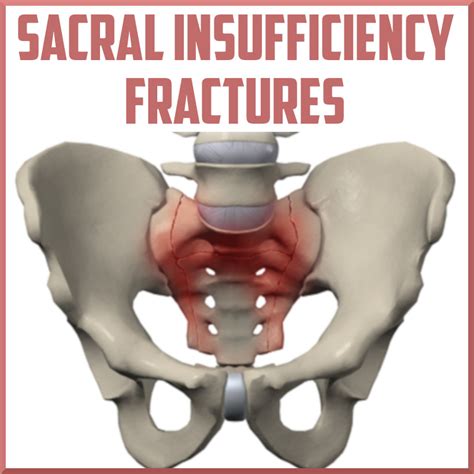 Sacral Insufficiency Fractures - Sports Medicine Review - Sports ...