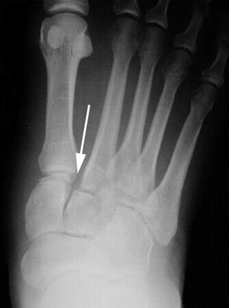 Lisfranc Injury — Associate Professor Roderick Kuo