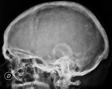 Salt and pepper sign (skull) | Radiology Reference Article | Radiopaedia.org