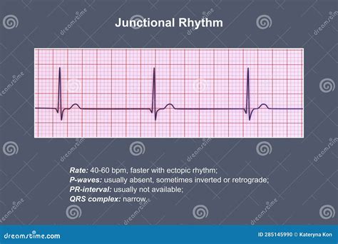 Junctional Rhythm