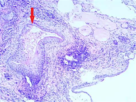 Thyroglossal Duct Cyst Histology