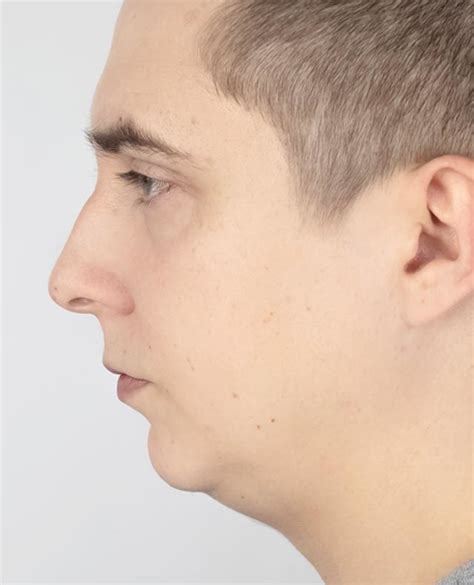 Weak Jaw | Zenith Cosmetic Clinics