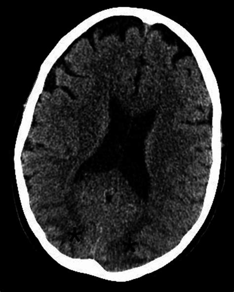 Cureus Persistent Cortical Blindness Following Posterior Reversible ...