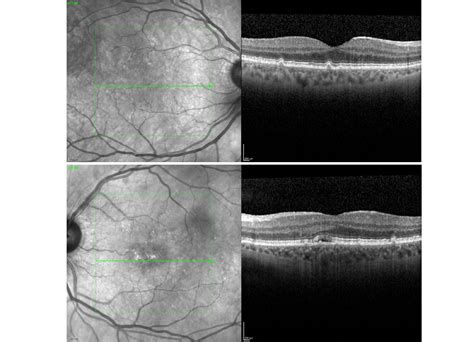 Macular Degeneration – Dean Samarkovski Optometrist