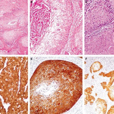 Vulvar intraepithelial neoplasia of the differentiated (simplex) type... | Download Scientific ...