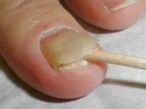 Nail psoriasis symptoms - YouTube