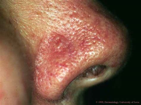 Skin Cancer Picture from UI Dermatology (Hardin MD / uIowa.edu)