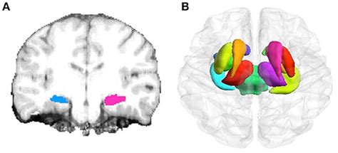 Frontiers | Identifying Morphological Patterns of Hippocampal Atrophy in Patients With Mesial ...