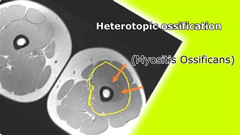 Heterotopic ossification (Myositis Ossificans) /Medical Documentary ...