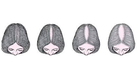 Female pattern baldness: Types, causes and treatment – Payal Social Enterprises