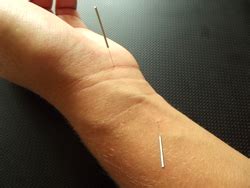 Acupuncture and electroacupuncture are both helpful for carpal tunnel ...