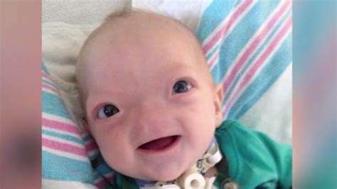 'Miracle baby' Eli, born without a nose, dies at 2 | WJLA