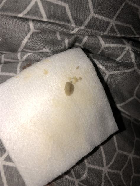 HS flare was hurting so I went to clean it and this little number came off on the gauze. HS ...