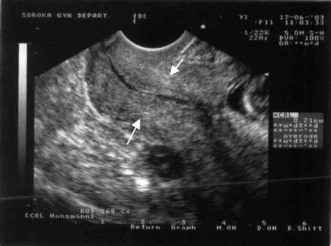 Tightening McDonald cerclage suture under sonographic guidance ...