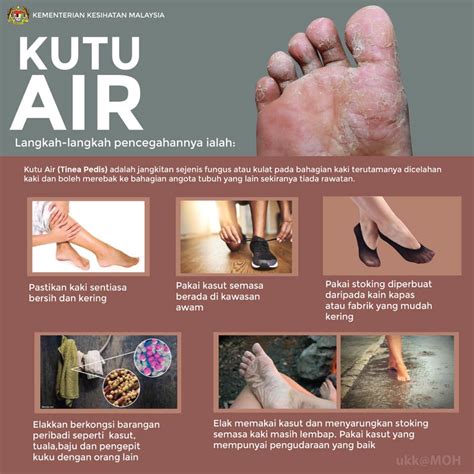 KUTU AIR: KERAP DIPANDANG REMEH - I-Medik