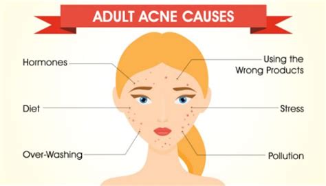 7 Adult Acne Diet Food: You Must Eat To Get Rid Of Acne