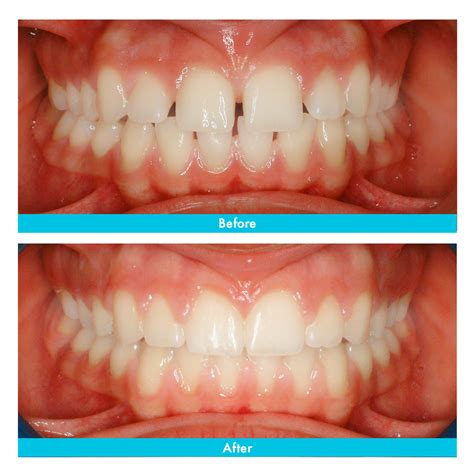 Before and After – SoClear – Clear Aligners