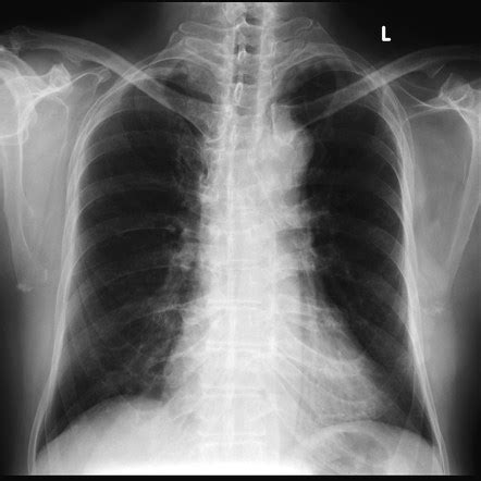 Coracoclavicular joint | Radiology Case | Radiopaedia.org