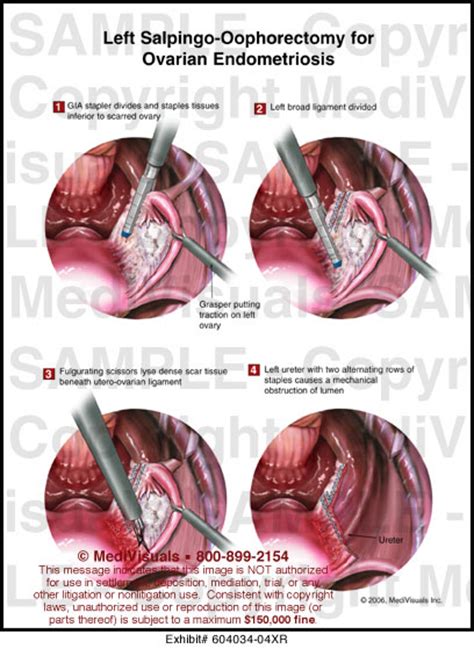 Left Salpingo-Oophorectomy for Ovarian Endometriosis