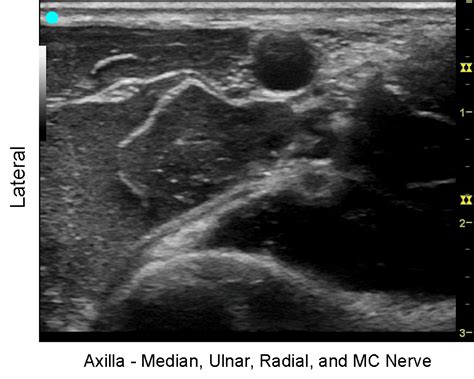 Radial Nerve: Ultrasound Radial Nerve Block At Elbow