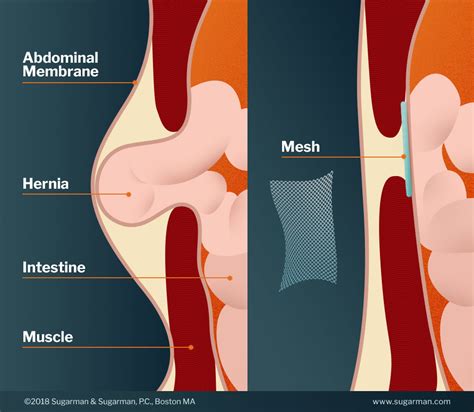 Hernia Mesh Failures and Injuries » Sugarman