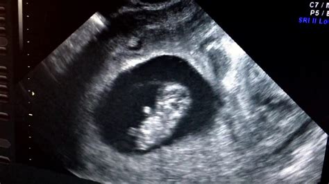 First trimester ultrasound video baby is waving at us. - YouTube