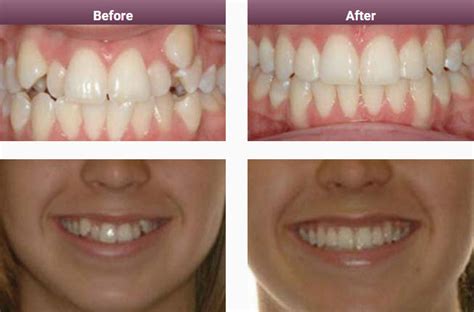 Invisalign Results & Case Studies Melbourne | Smile Solutions