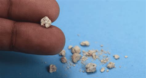 A TCM Physician Reveals How Kidney Stones Can Be Treated with TCM