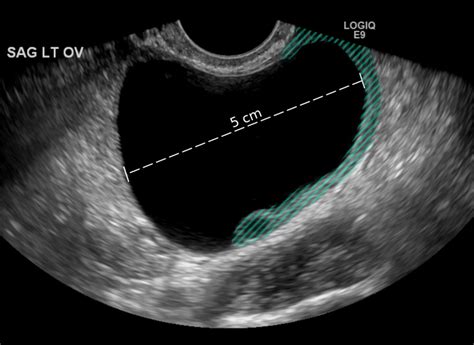 Ruptured Ovarian Cyst