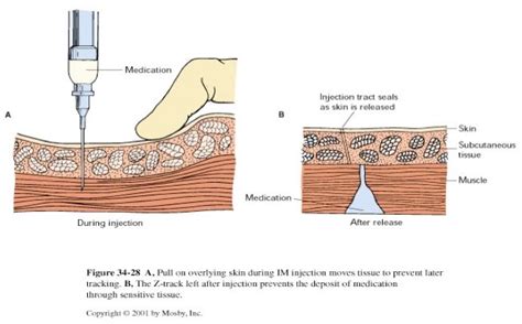 IM Injections - Nursing Needles