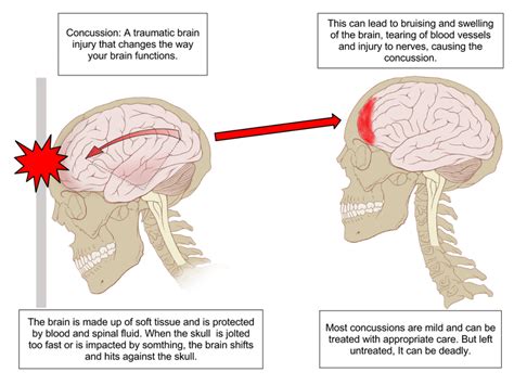 Difference Between Concussion and Contusion | Compare the Difference ...