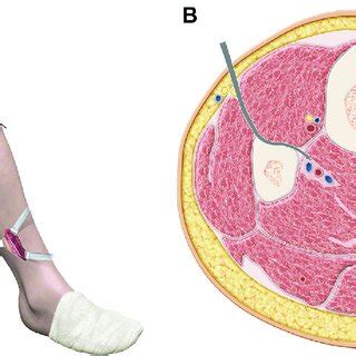 Illustration showing proximal exposure of the peroneal artery (A) and... | Download Scientific ...