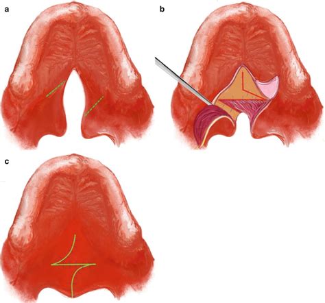 Cleft Lip and Palate Treatment | Pocket Dentistry