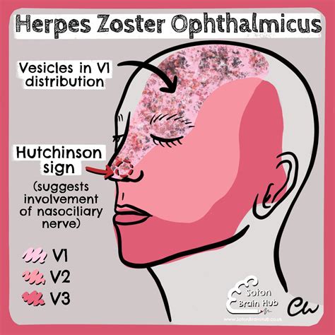 Herpes Zoster Ophthalmicus Vesicles