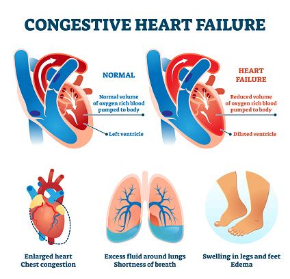 Congestive Heart Failure Vector Illustration Labeled Medical Compare ...