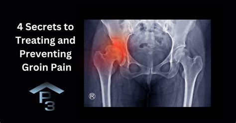 4 Secrets To Treating and Preventing A Groin Strain