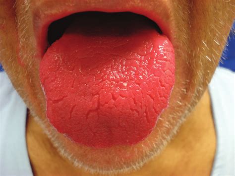 7 Señales de alerta que tu lengua te avisa sobre tu salud