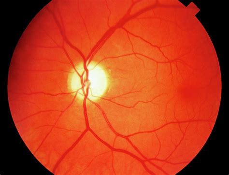 Ophthalmoscope View Of Retina With Optic Atrophy Photograph by Sue Ford ...