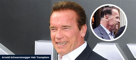 Arnold Schwarzenegger Hair Transplant - Smile Hair Clinic